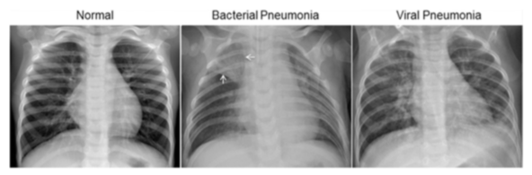 Side-by-side chest X-ray images showing a normal lung scan on the left and a pneumonia scan on the right. The pneumonia image contains visible cloudy opacities compared with the clearer lung fields in the normal image.