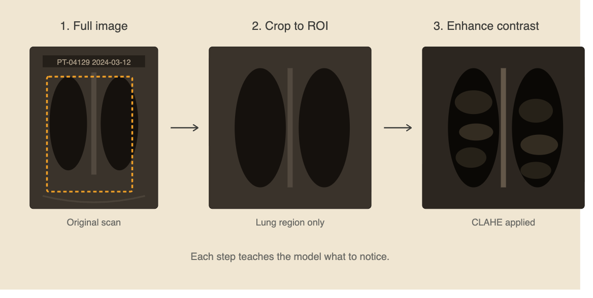 Three-panel illustration showing a chest X-ray before and after feature enhancement. The first panel shows the original image, the second highlights the lung region of interest, and the third shows the image after CLAHE contrast enhancement with lung textures appearing more visible.