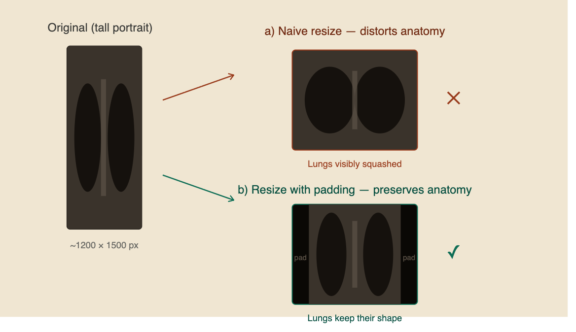 Comparison of two chest X-ray resizing approaches. One image is stretched into a square shape, distorting the lungs, while the second preserves the original aspect ratio by adding padding around the image. The aspect-ratio-preserving approach is highlighted as the preferred method.
